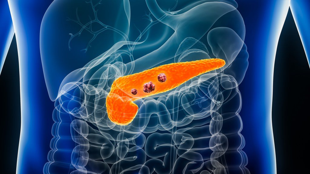 Illustration of pancreatic cancer inside a male body, with three tumors visible on the orange pancreas.